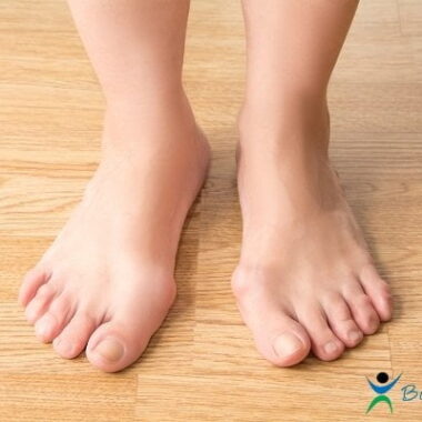 Deformacje stopy – leczenie i wszystko, co musisz o nich wiedzieć